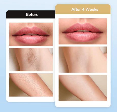 Depiladora de Luz Pulsada com Alta Energia - 5