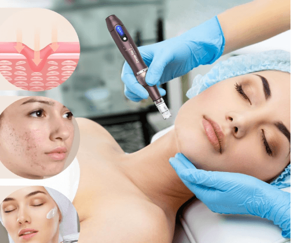 Kit Dr.Pen A10 DermaPen Microneedling Caneta sem Fios + 22 Recargas - 2