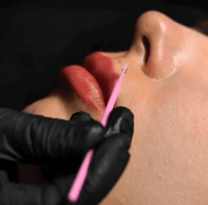 Stop Red (Anti-Edema Gel) Durante e Pós Micro – AS Company - 3