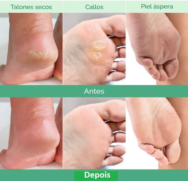 💥 EM ALTA: Máscara Esfoliante Pés Testada Dermatologicamente - 2