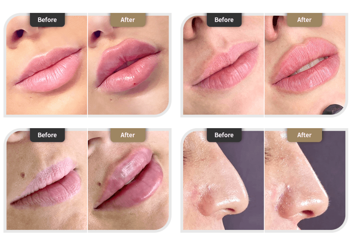 Elaxfill Classic 1ml Ácido Hialurónico Reticulado - Lábios - 2