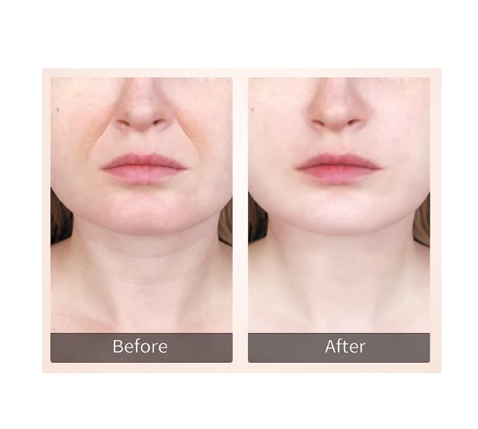 Massajador EMS Lifting & 45 °C Rosto Pescoço - 4