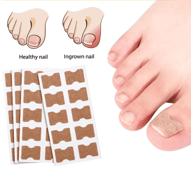Ingrown Toenail Kit - 2