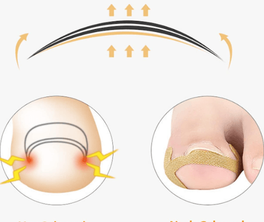 Ingrown Toenail Kit - 3